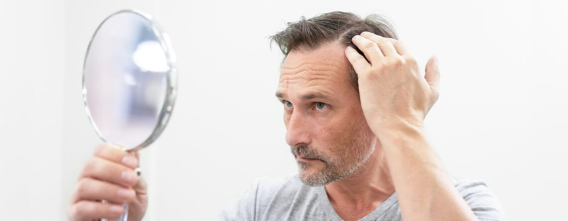 Hair Transplant in Delhi