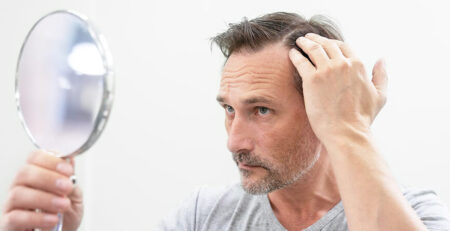 Hair Transplant in Delhi