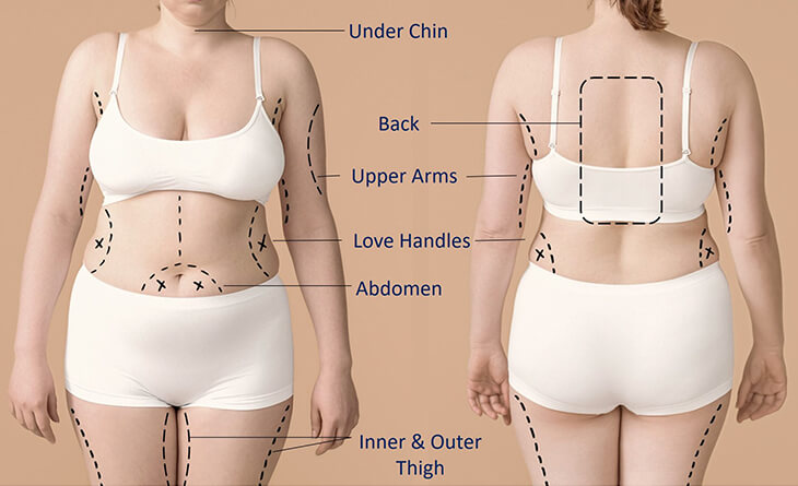 Liposuction surgery procedure