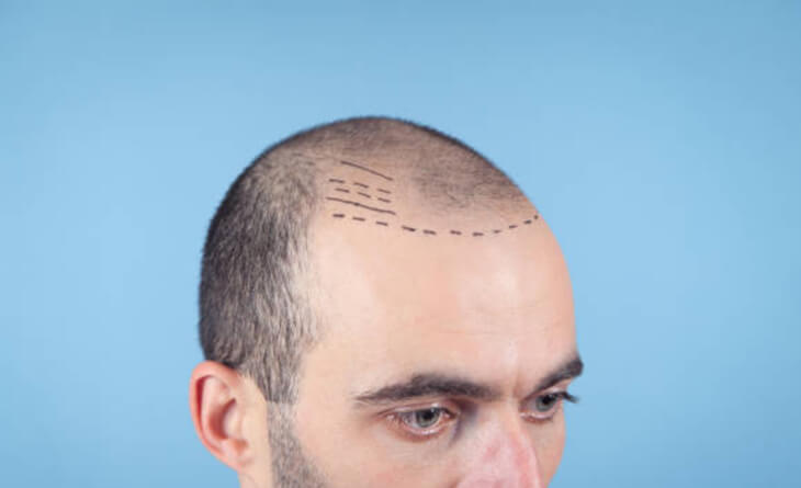 Hair Transplant surgery procedure