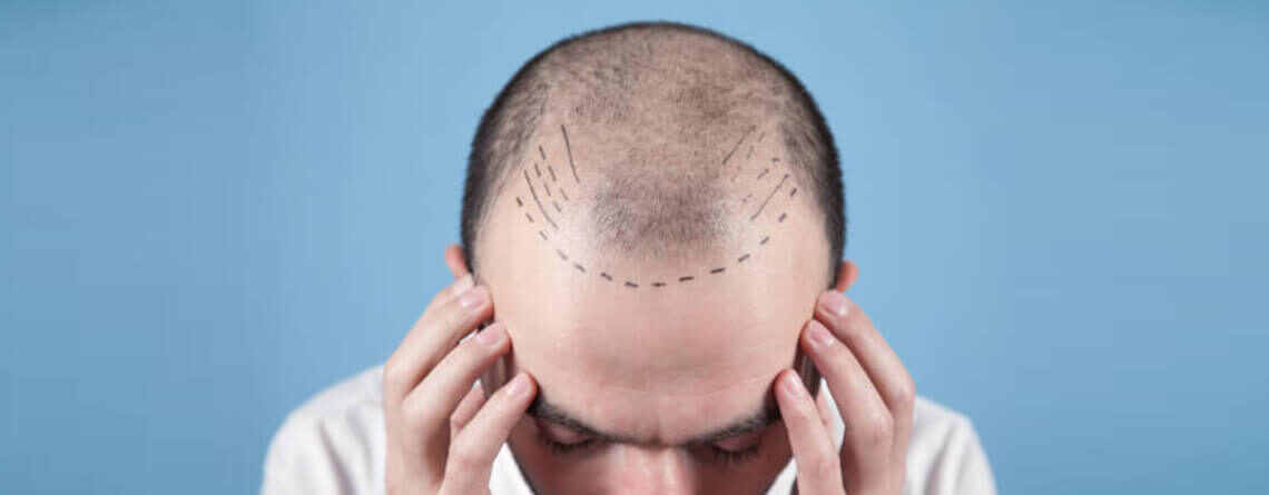 Hair Transplant surgery procedure