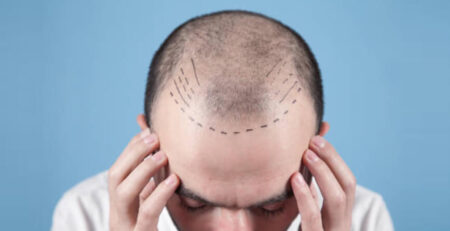 Hair Transplant surgery procedure