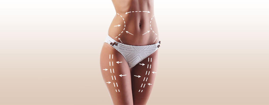 Liposuction Surgery in Delhi