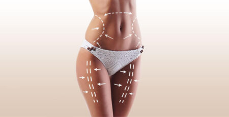 Liposuction Surgery in Delhi