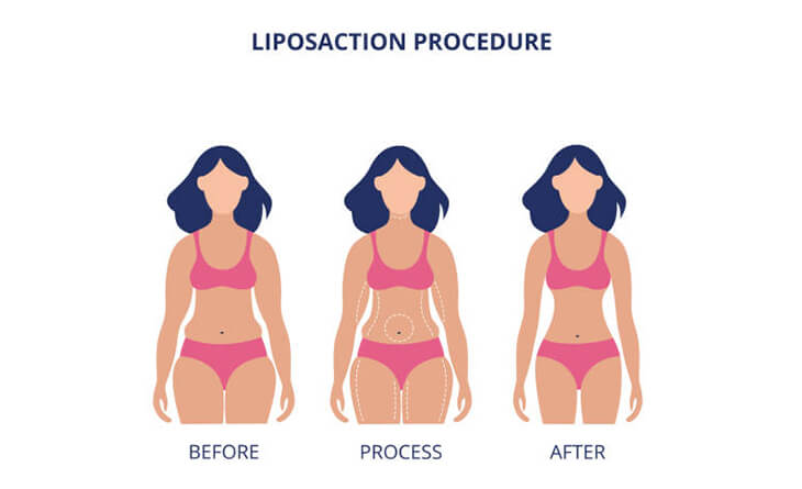 Liposuction Surgery in Delhi