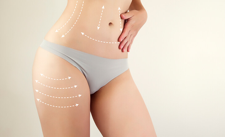 Liposuction Surgery in Delhi