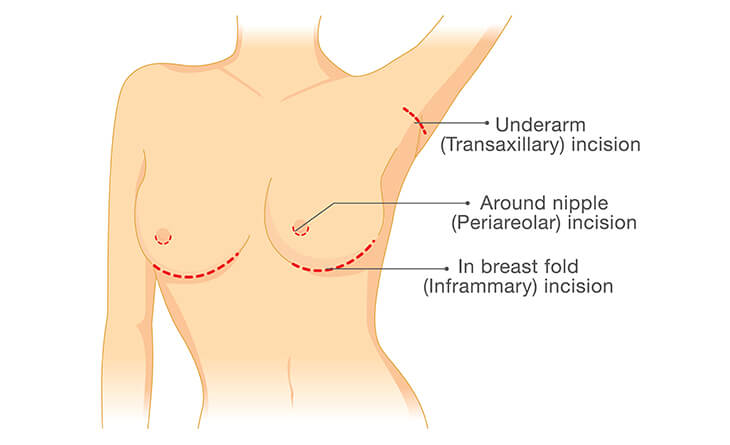 breast reduction surgery in Delhi