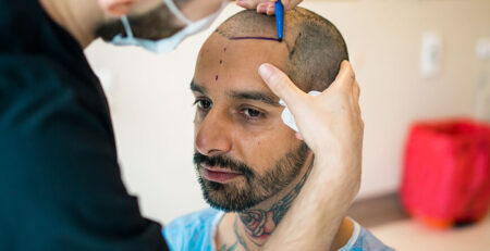 Hair Transplant in Delhi