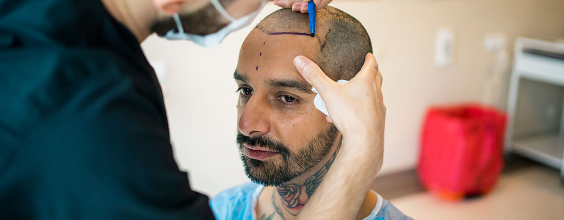 Hair Transplant in Delhi