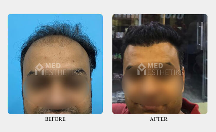 Hair Transplant Surgery Before After Result - Dr Lokesh Handa - Best Plastic Surgeon in Delhi -01