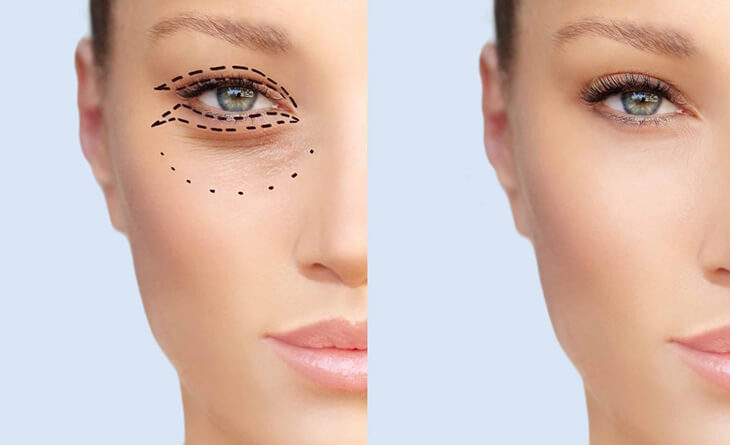 blepharoplasty surgery in Delhi