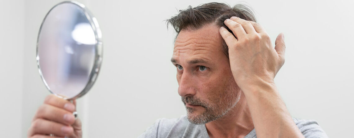 Hair Transplant in Delhi