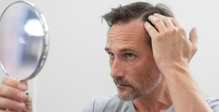 Hair Transplant in Delhi