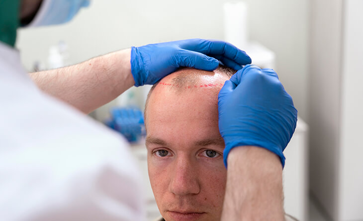 Hair Transplant in Delhi