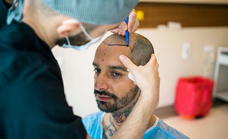 Hair Transplant in Delhi