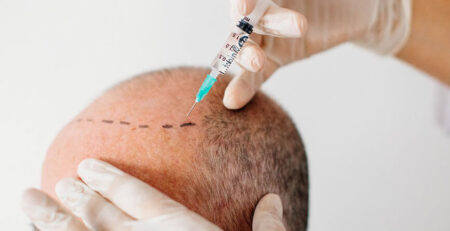 Hair Transplant in Delhi