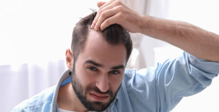 Hair Transplant in Delhi