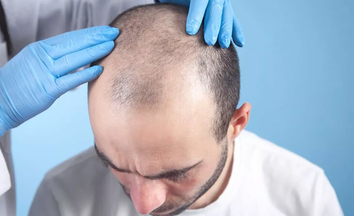 Hair Transplant in Delhi