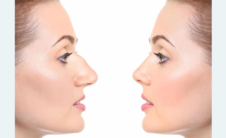 Rhinoplasty surgery in Delhi