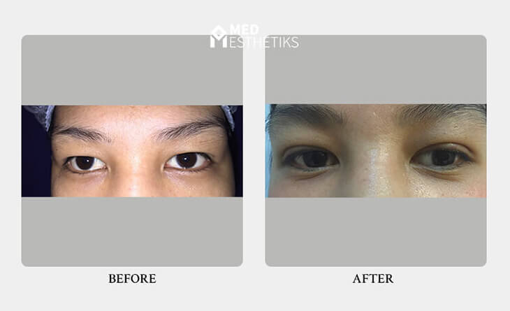 Blepharoplasty surgery