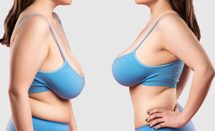 Breast reduction surgery