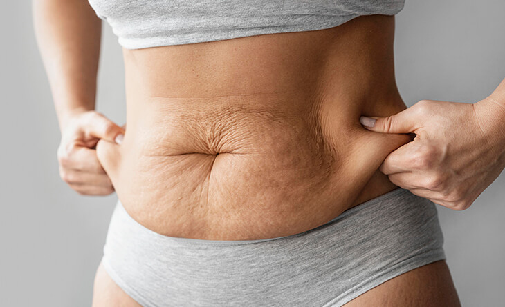 How Much Does Tummy Tuck Surgery Cost In India?