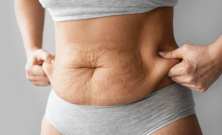 How Much Does Tummy Tuck Surgery Cost in India?