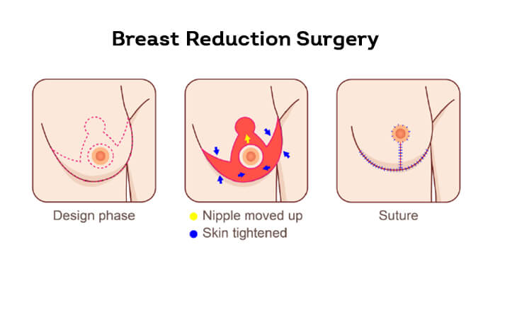 breast reduction surgery