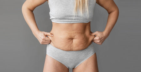 Tummy tuck surgery