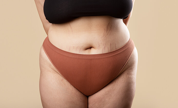 How Much Does Tummy Tuck Surgery Cost In India?