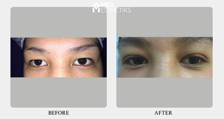 eyelid surgery