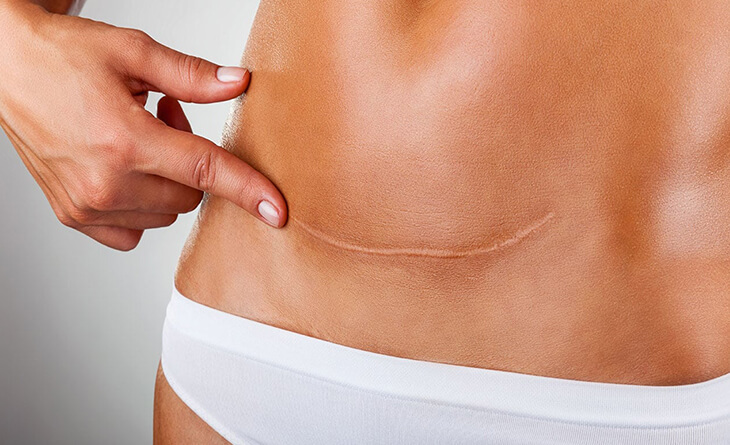 liposuction surgery