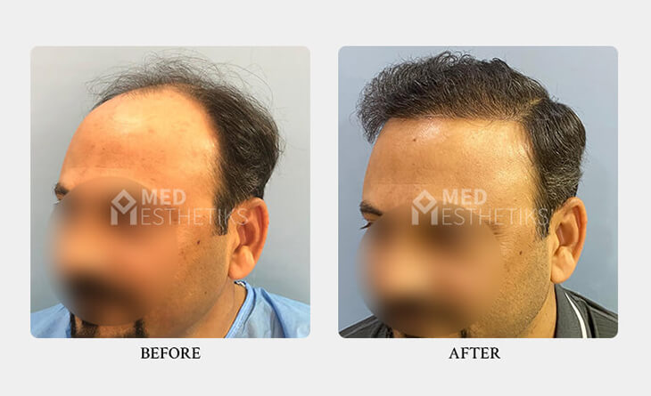 FUE hair transplant