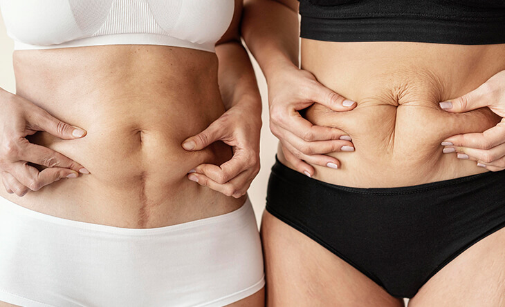 Tummy Tuck Surgery Procedure