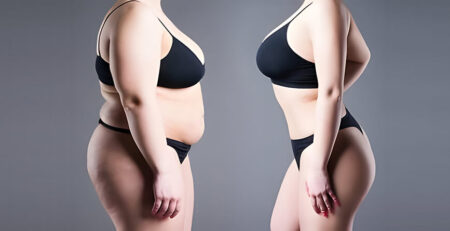 Breast Reduction Surgery