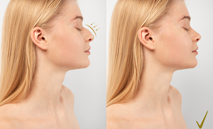 rhinoplasty surgery