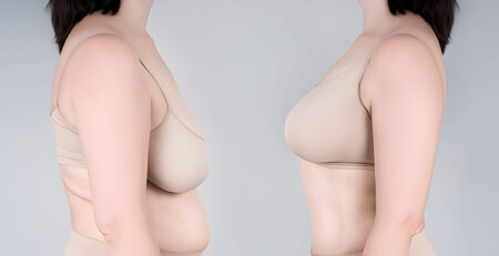 Breast Augmentation Surgery