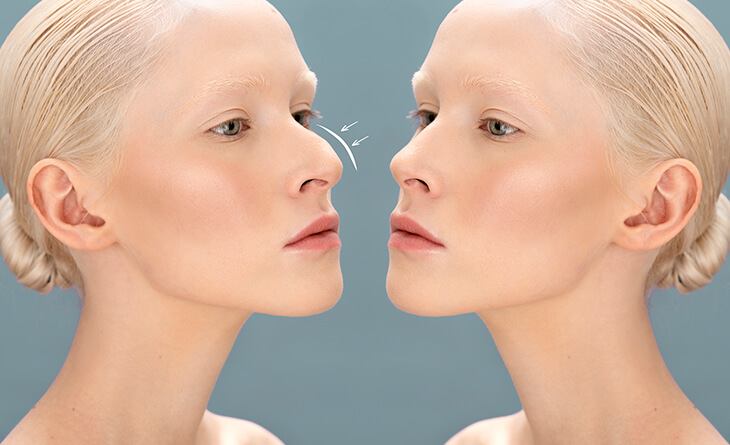 rhinoplasty surgery