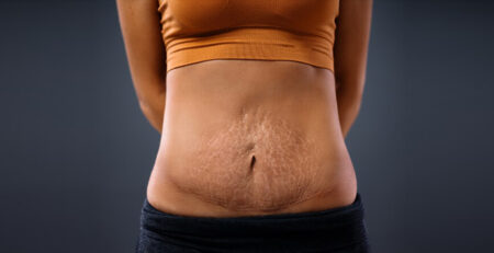 Tummy Tuck Surgery