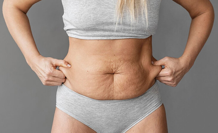 Tummy Tuck Surgery