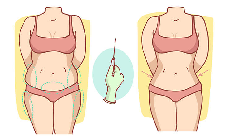 Preoperative Preparations for Liposuction Surgery
