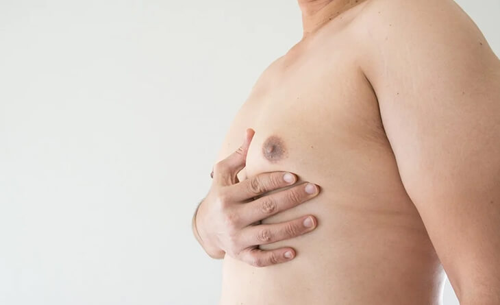 Gynecomastia Surgery