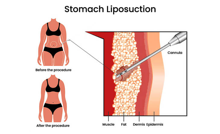 Liposuction Surgery