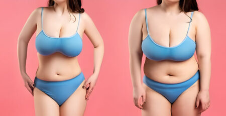 Breast Reduction Surgery