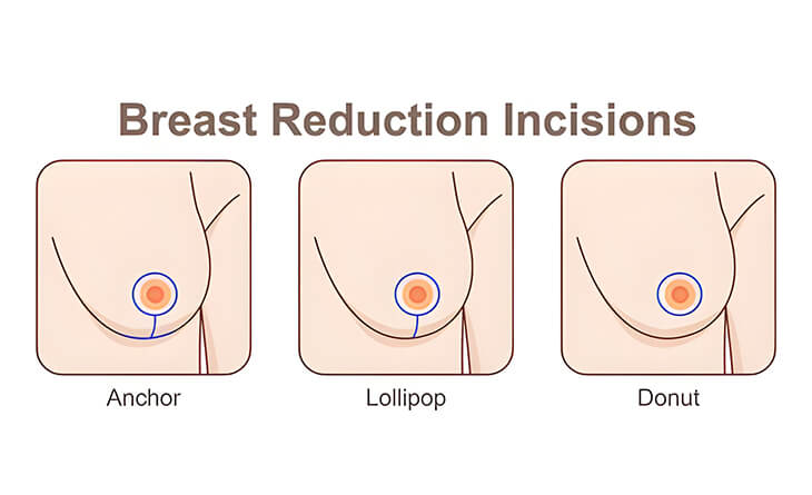 Breast Reduction Surgery