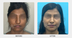 Rhinoplasty Surgery Results- Med Esthetiks -07