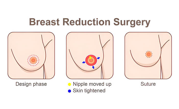 breast reduction surgery
