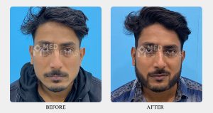 Beard Hair Transplant - Med Esthetiks Delhi - 01