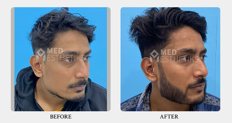Beard Hair Transplant - Med Esthetiks Delhi - 02