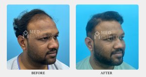 Hair Transplant - Dr Lokesh Handa - Med Esthetiks Delhi - 01